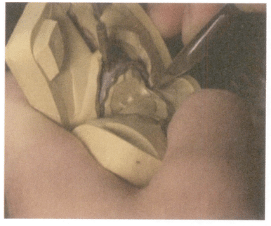 Figur 3-9 Firepunktsposisjonering av støpeformen