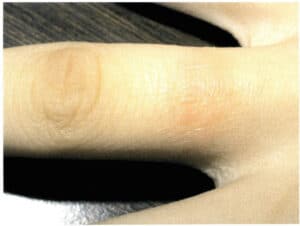 Figure 3-36 Allergic symptoms appear at the site of wearing nickel K white gold jewelry.