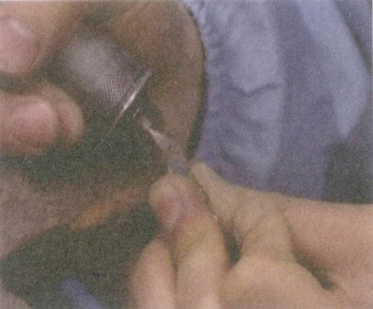 Figure 4-9 remove Sand holes