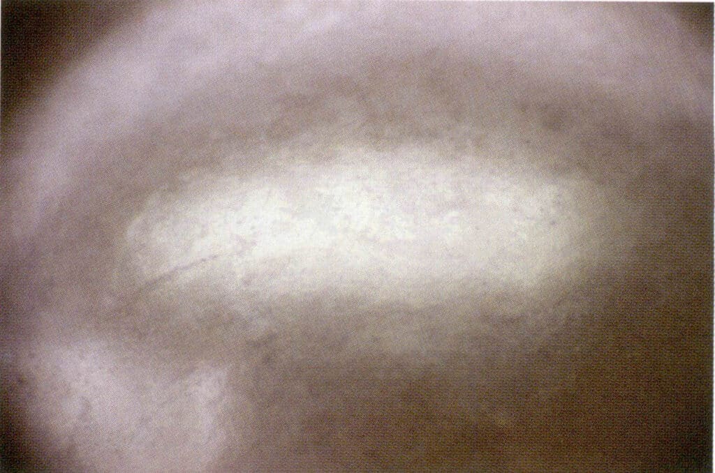 Figure 1-5-77 Scratches on the surface of coated pearls (under microscope)