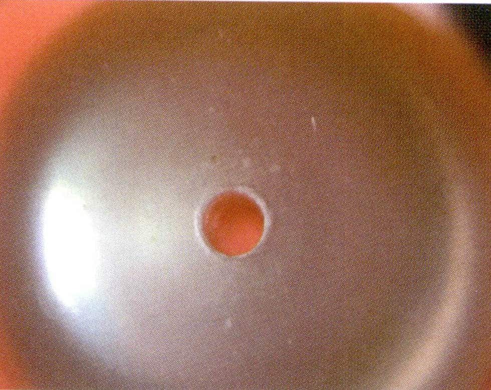 Figure 1-6-13 Drilling characteristics of freshwater cultured pearls (microscopic observation)