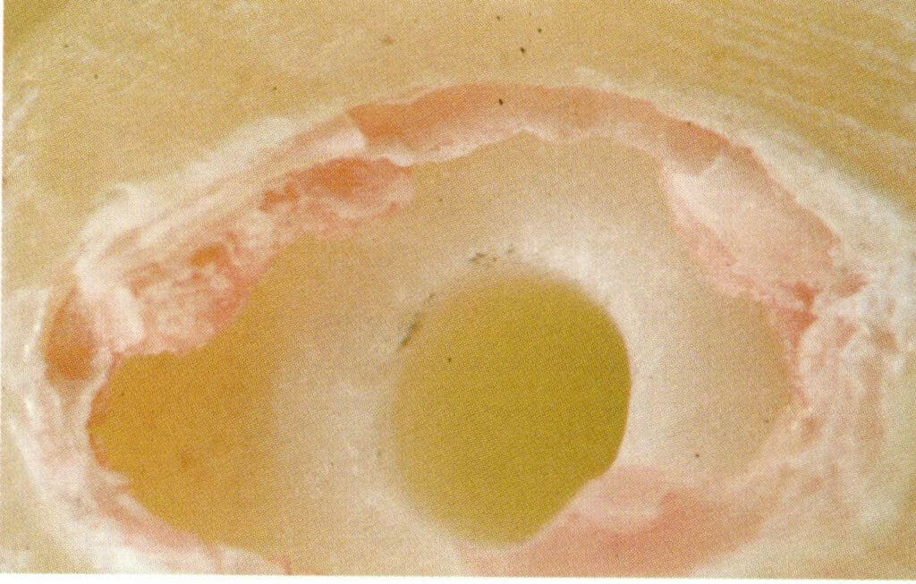 Figure 1-6-15 Drilling characteristics of seawater cultured pearls (microscopic observation)