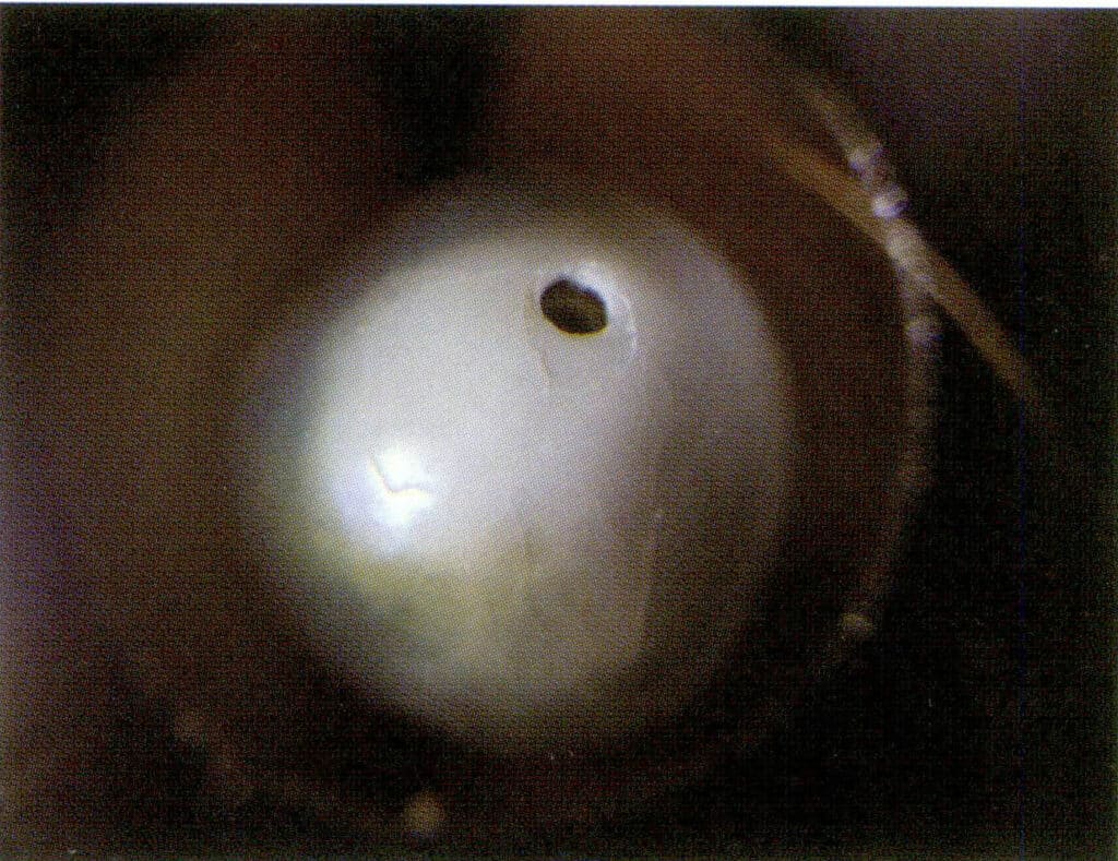 Figure 1-2-55 Layered structure visible on the surface of the nucleated pearl layer and at the pearl nucleus
