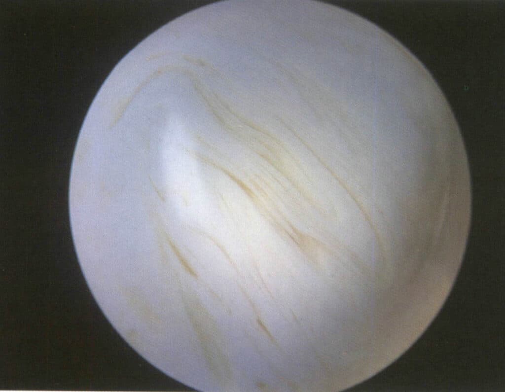 Şekil 4-2-42 Plastik Akış Desenleri (Dikey Aydınlatma Yöntemi, 30X)