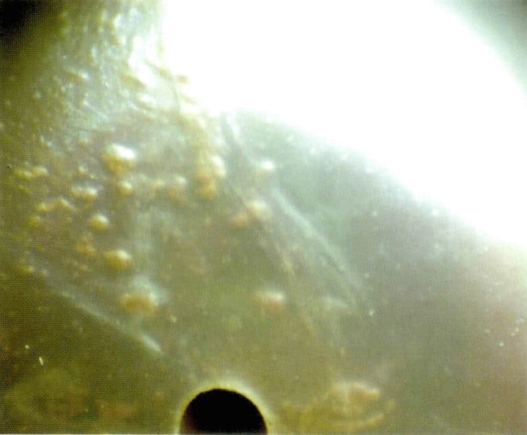 Figure 7-2 Papules appearance of the pearl surface