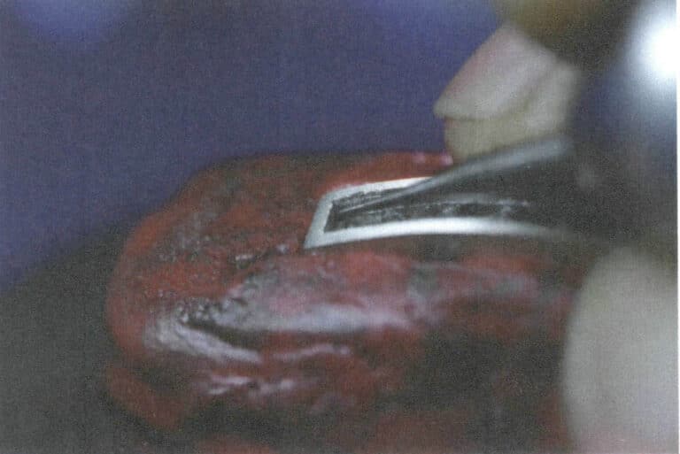 Figura 8-7 Entalhe da posição angular com uma pequena broca esférica