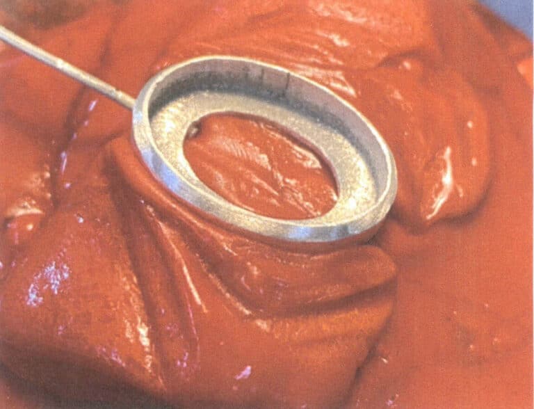 Figure 2-24 Fixing the Metal