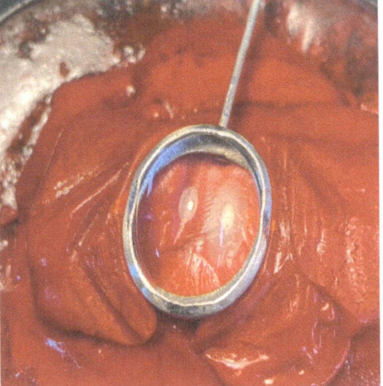 Figure 2-28 Symmetrical point fixation (four points)