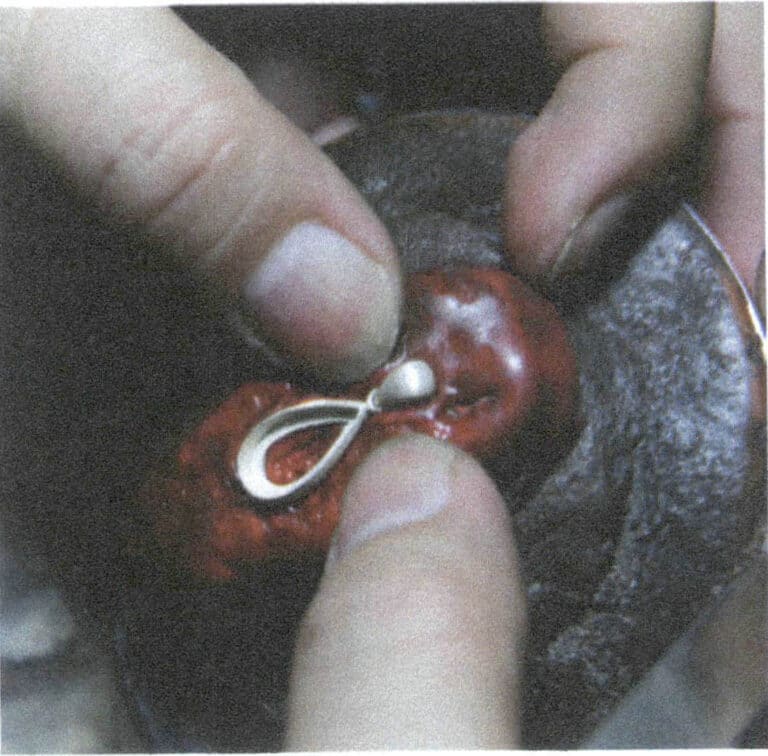 Figure 2-48 Fixing the Metal