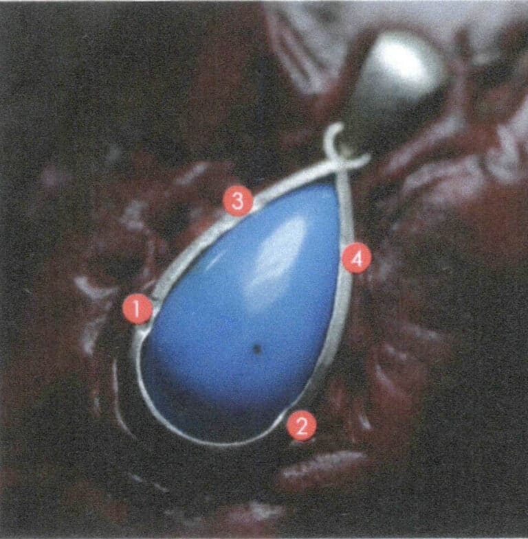 Figure 2-50 Point Fixation Sequence