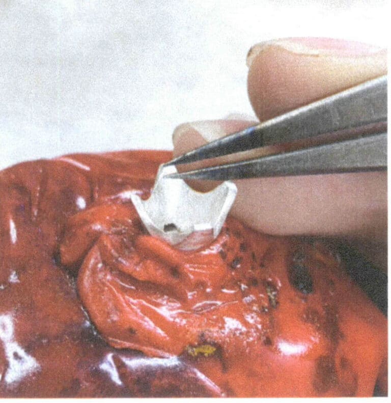 3-42. ábra A kőbeállító pozíció nyitásának helyének kijelölése