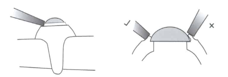 Figura 6-29 Ângulo do cinzel de ponta plana